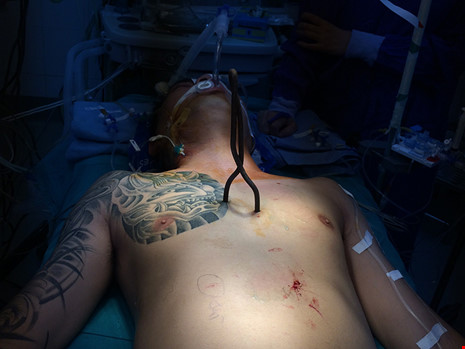 Cứu sống bệnh nhân bị đâm xuyên tim