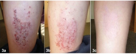 Điều trị viêm da cơ địa mạn tính bằng Dr Michaels Dermatinex thảo dược