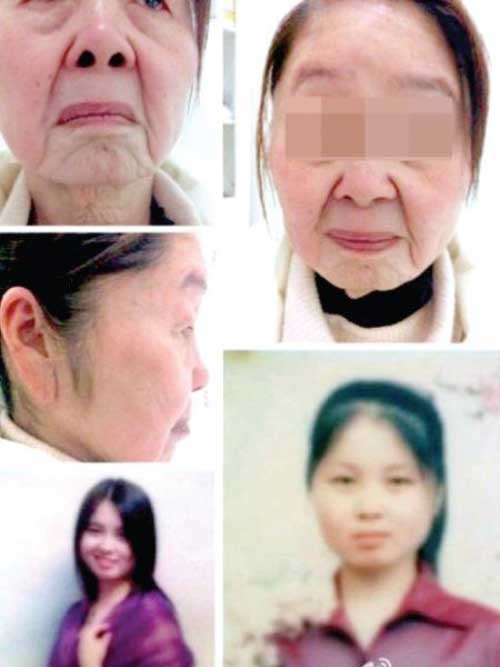Mỹ phẩm giả không rõ nguồn gốc, thành phần sẽ gây hại trực tiếp cho làn da mong manh của bạn, tiếp theo đó là vô vàn tác hại mà bạn không thể ngờ tới.  Mỹ phẩm giả ngoài việc không thể đáp ứng nhu cầu làm đẹp của bạn, mà còn tiềm ẩn nhiều nguy cơ cho làn da. Vì các thành phần tạo nên chúng thường là các hoá chất không an toàn, có thể gây dị ứng cho làn da sau khi sử dụng. Nặng hơn, nếu dùng lâu dài sẽ khiến da bị tổn thương, lão hoá nhanh chóng.  Trường hợp cô gái Trung Quốc Hu Juan là một minh chứng, hồi chuông cảnh tỉnh cho chị em phụ nữ trước nay vẫn dùng mỹ phẩm không rõ nguồn gốc.