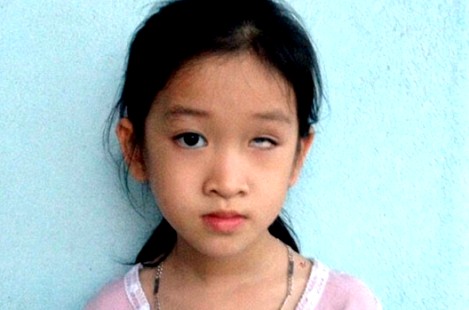 Bé gái lớp 1 bị bạn ném thước kẻ gây mù mắt