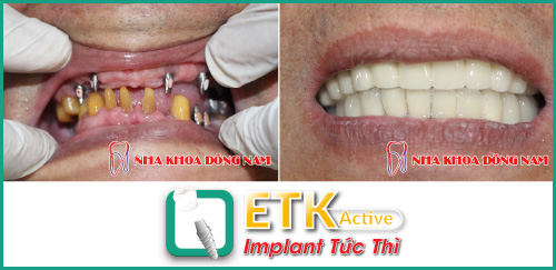 Những trường hợp nào có thể cấy ghép Implant ETK Active