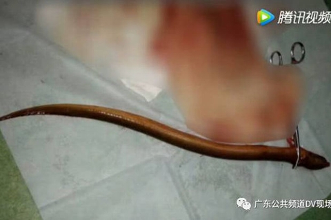 Kinh hoàng lươn dài 50cm quẫn đạp trong bụng người