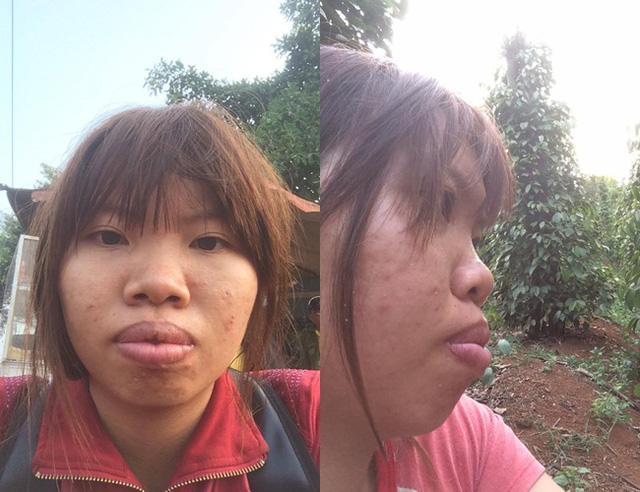 ﻿﻿﻿Bị cô lập xa lánh, cô gái trẻ chi hàng trăm triệu đồng trùng tu nhan sắc  Thời gian gần đây, Quách Thị Kim Phương (Đắc Nông) khiến cộng đồng mạng xôn xao khi chia sẻ quá trình phẫu thuật thẩm mỹ khuôn mặt mình.