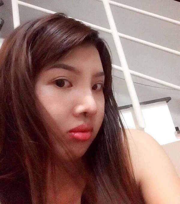 Sau khi phẫu thuật, gương mặt Phương đã hài hòa hơn