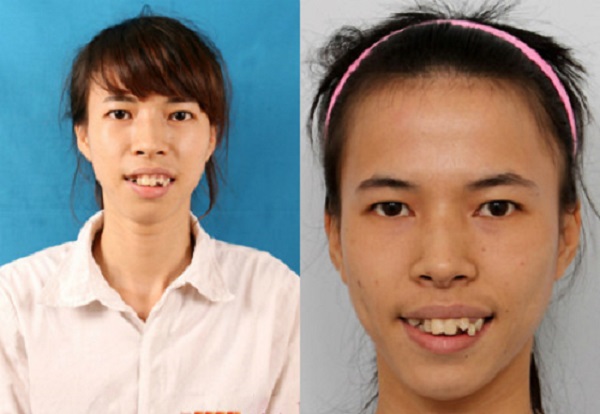 Hình ảnh của Dịu trước khi phẫu thuật thẩm mỹ.