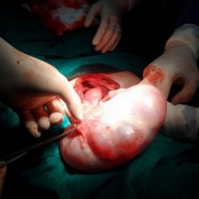 U buồng trứng gần 2kg vẫn tưởng… béo bụng