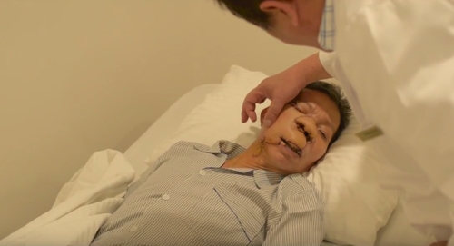 5 ngày sau mổ, ông Sứ đã hồi phục sức khỏe, khối u được loại bỏ, phần tạo hình tiến triển tốt