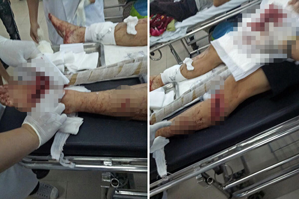 Chồng bị côn đồ chém nhập viện vì... bênh vợ