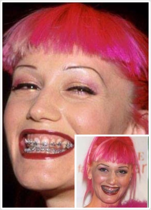 8. Gwen Stefani   Gwen Stefani từng có chia sẻ rất thú vị rằng cô đã từng ao ước được có một bộ niềng răng từ bé mà không có đủ tiền để mua. Sau khi đã kiếm đủ tiền, cô đã sắm cho mình một bộ niềng để thỏa mong ước. Đây cũng là lý do nữ ca sĩ rất tự tin khoe bộ niềng răng như một phụ kiện tại các thảm đỏ. Sau khi tháo niềng, Gwen Stefani đã có được nụ cười đẹp hơn rất nhiều.