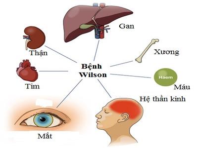 Bệnh Wilson: Phát hiện sớm giúp cứu cả cuộc đời của trẻ