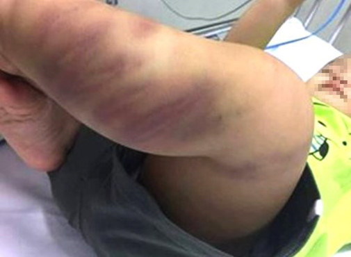 Đã tìm ra người nuôi bé trai hơn 1 tuổi nghi bị bạo hành