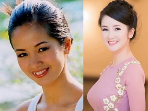 Với phương pháp niềng răng cô Bống trông khác lạ, rạng rỡ và trẻ trung hơn hẳn nhờ hàm răng đều tăm tắp. 