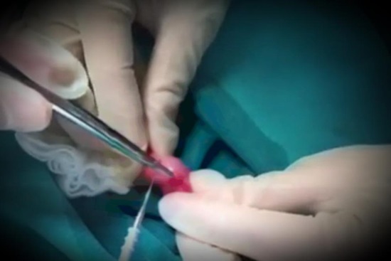 Hà Nội: Phát hiện bé trai 2 tuổi bị sùi mào gà