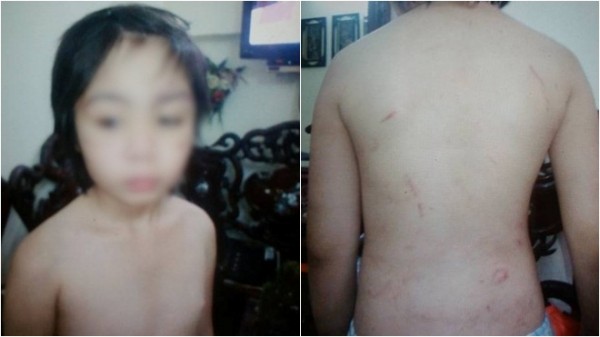 Bé trai 10 tuổi nghi bị bố và mẹ kế bạo hành gãy xương sườn, rạn sọ não