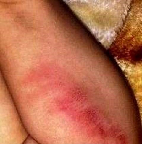 Vết bầm đỏ trên đùi của cháu V.