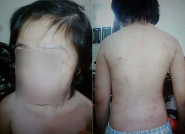 Vụ bé trai 10 tuổi bị bạo hành: Xử lý bố đẻ và mẹ kế thế nào?