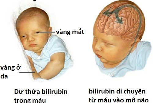 Thời gian vàng phòng ngừa biến chứng thần kinh do vàng da ở trẻ sơ sinh