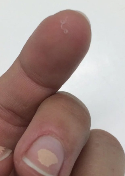 Những con sán còn sống nguyên được gắp ra ngoài dài khoảng 3cm