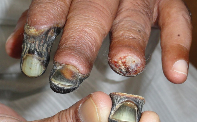 Ma túy &quot;thây ma&quot; Krokodil khiến cơ thể bị thối rữa đã xuất hiện ở Anh